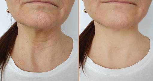 Reviewers Say Their Necks Looked Better Just 1 Day After Using This Cream