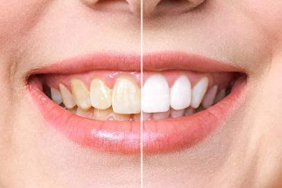 The Best Teeth Whitening Deals in the Amazon Spring Beauty Premiere Event