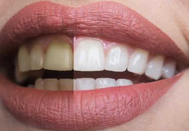 Whiter Teeth in 15 Seconds! Shop This $20 Color-Correcting Foam on Prime