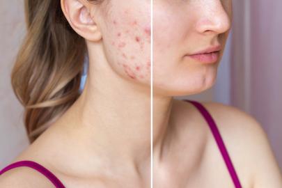 This $17 Serum Is Making Cystic Acne a Thing of the Past for Shoppers