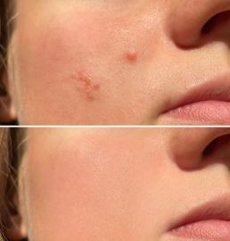 This Liquid Acne Patch Clears Breakouts Practically on Contact