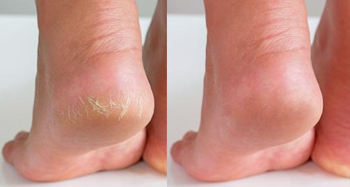 Calloused, Cracked Feet? Grab This Medicated Skin Salve for Sandal Weather