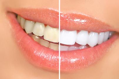 Hate Wearing Whitening Strips? Check Out This Teeth Whitening Pen