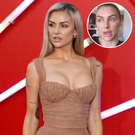 Lala Kent Shows Off New Puffy, Bruised Lips After Getting Injections