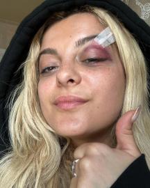 Bebe Rexha Shares Black Eye Pics After Phone Hits Her Face: 'I'm Good'