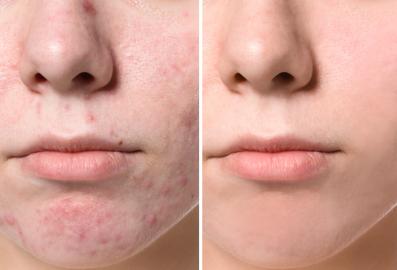 You Have to See the Before-and-After Snaps of This Cystic Acne Treatment