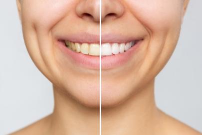 Reviewers Say This Plaque Remover Helps Them See Their Smiles Again
