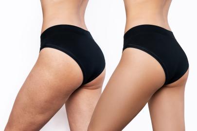 The 10 Best Lotions and Treatments to Help Fade Cellulite