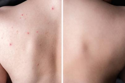 Fight Stubborn Body Acne With This Effective and User-Friendly Spray