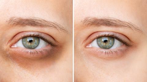 This Eye Cream Reduces the Size and Color of Persistent Dark Circles