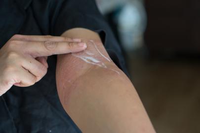 The 10 Best Lotions for Eczema That Actually Provide Relief