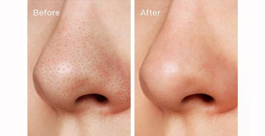 Strawberry Nose? This 3-Step Pore Kit Is Dissolving Blackheads 