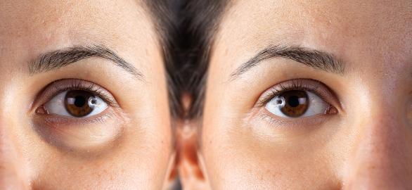 You Could See a Noticeable Difference After Just 3 Days With This Eye Cream