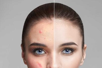 Banish Zits to the Beyond in Mere Hours With These Bestselling Pimple Patches