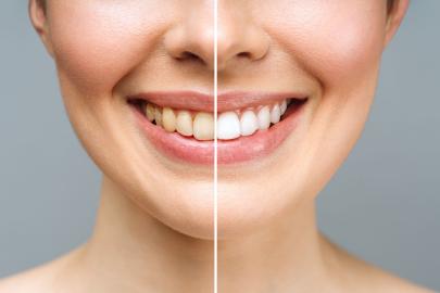 This Trusted Teeth Whitening Kit Promises a Brighter Smile in Just 20 Days