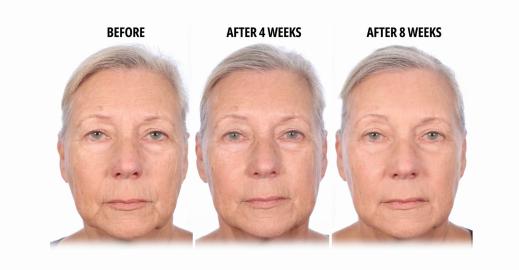 100% of Study Participants Saw Fewer Wrinkles With This Filler Treatment