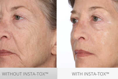 Channel Classic Beauty With Serious Skincare’s Wrinkle-Erasing InstaTox