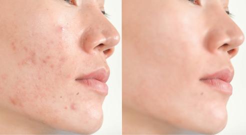 This ‘Secret’ Acne Treatment Is the Hidden Gem Your Skin’s Been Missing