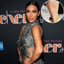 Inside Kim Kardashian's Struggle With Psoriasis: Her Journey in Photos