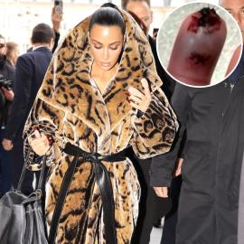 Kim Kardashian's ‘Bone Was Sticking Out’ After Gruesome Finger Injury