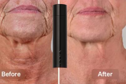 Want a Healthier, Younger Looking Neck? The Lyma Laser Starter Kit Can Help