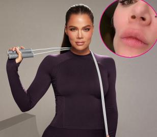 Khloe Kardashian Shares Before-and-After Pics of Facial Injections on Cheek