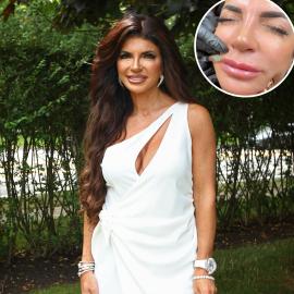 RHONJ’s Teresa Giudice Dissolves Her Lip Filler in Graphic Video