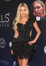 Brandi Glanville Describes Feeling Parasite 'Moving Around' in Her Face