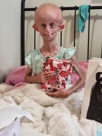 TikTok Star Beandri Booysen Dies at 19 From Rare Aging Disease