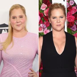Amy Schumer Found Out She Had Cushing Syndrome After ‘Moon Face’ Comments