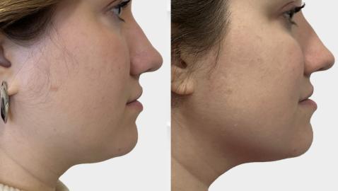A More Defined Jawline and Tighter Neck Are Possible With This Firming Serum
